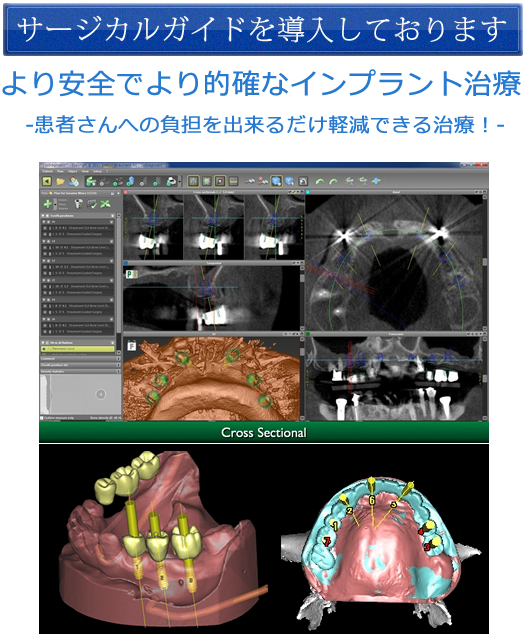 より安全でより的確なインプラント治療 患者さんへの負担を出来るだけ軽減できる治療
